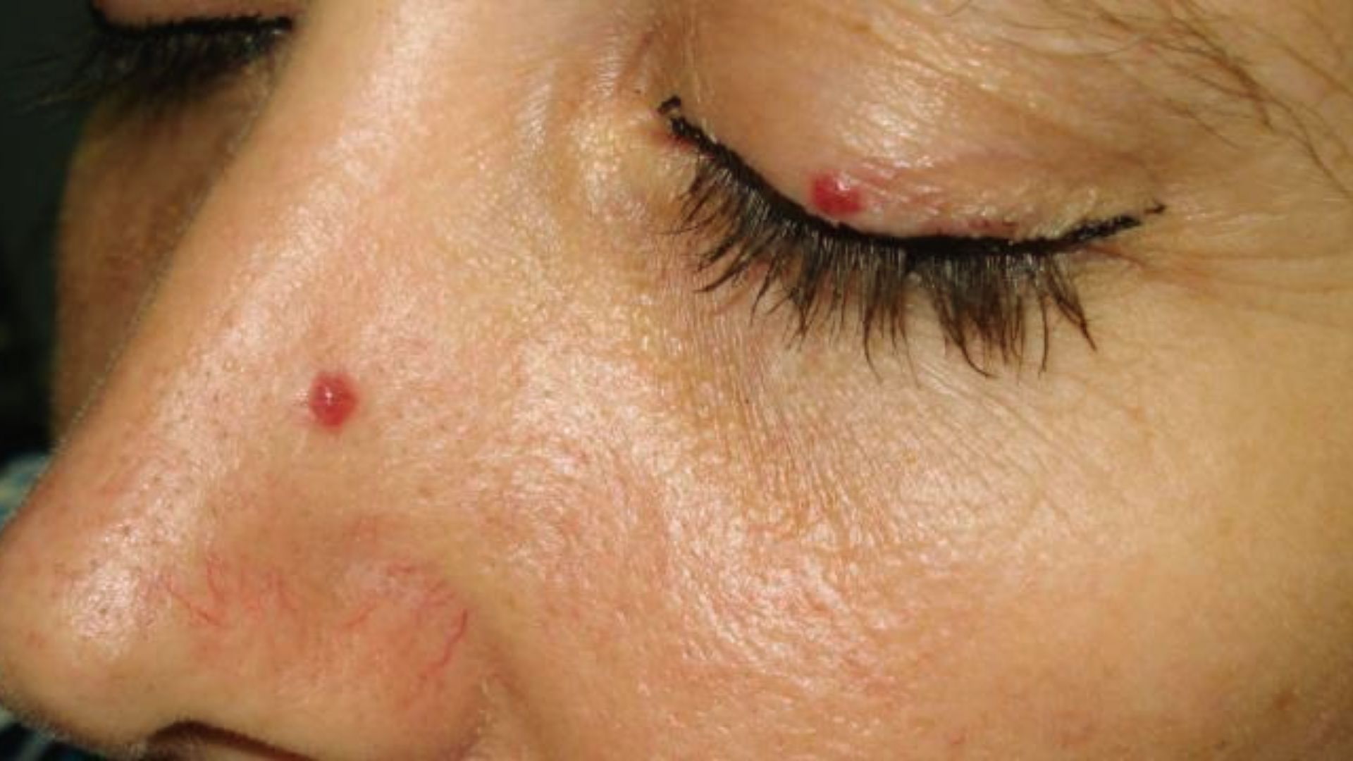 Close-up of a person's face with closed eyes, showing small red bumps on the nose and eyelid. Skin appears slightly textured and natural.