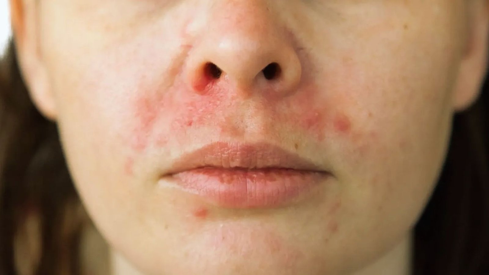 A woman with red spots on her face, looking directly at the camera with a neutral expression.