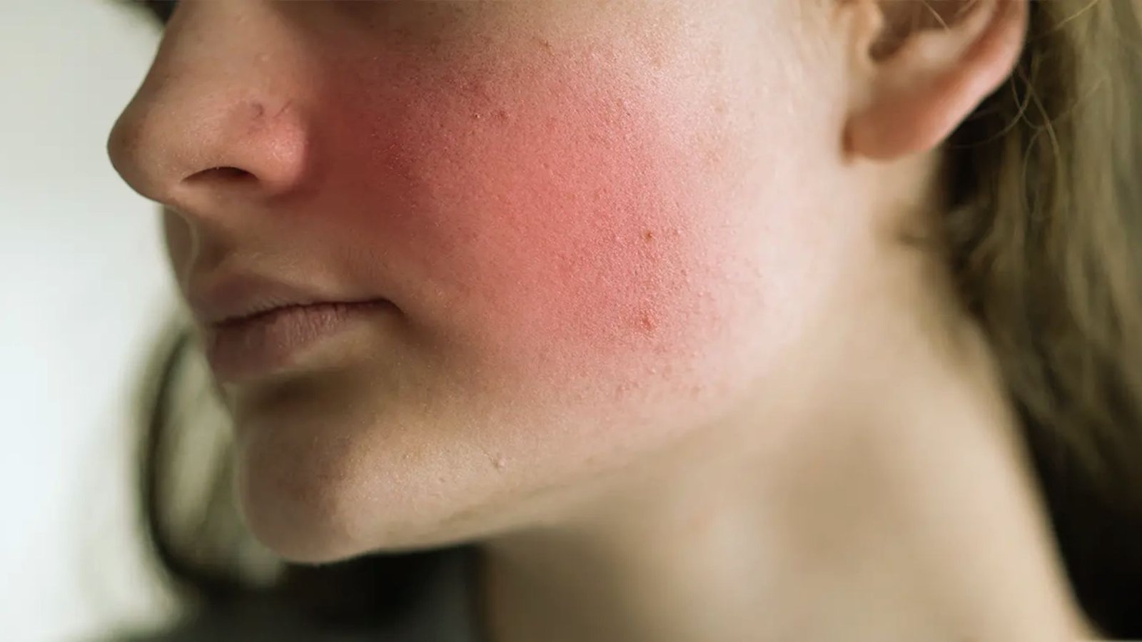 Eczema and Psoriasis