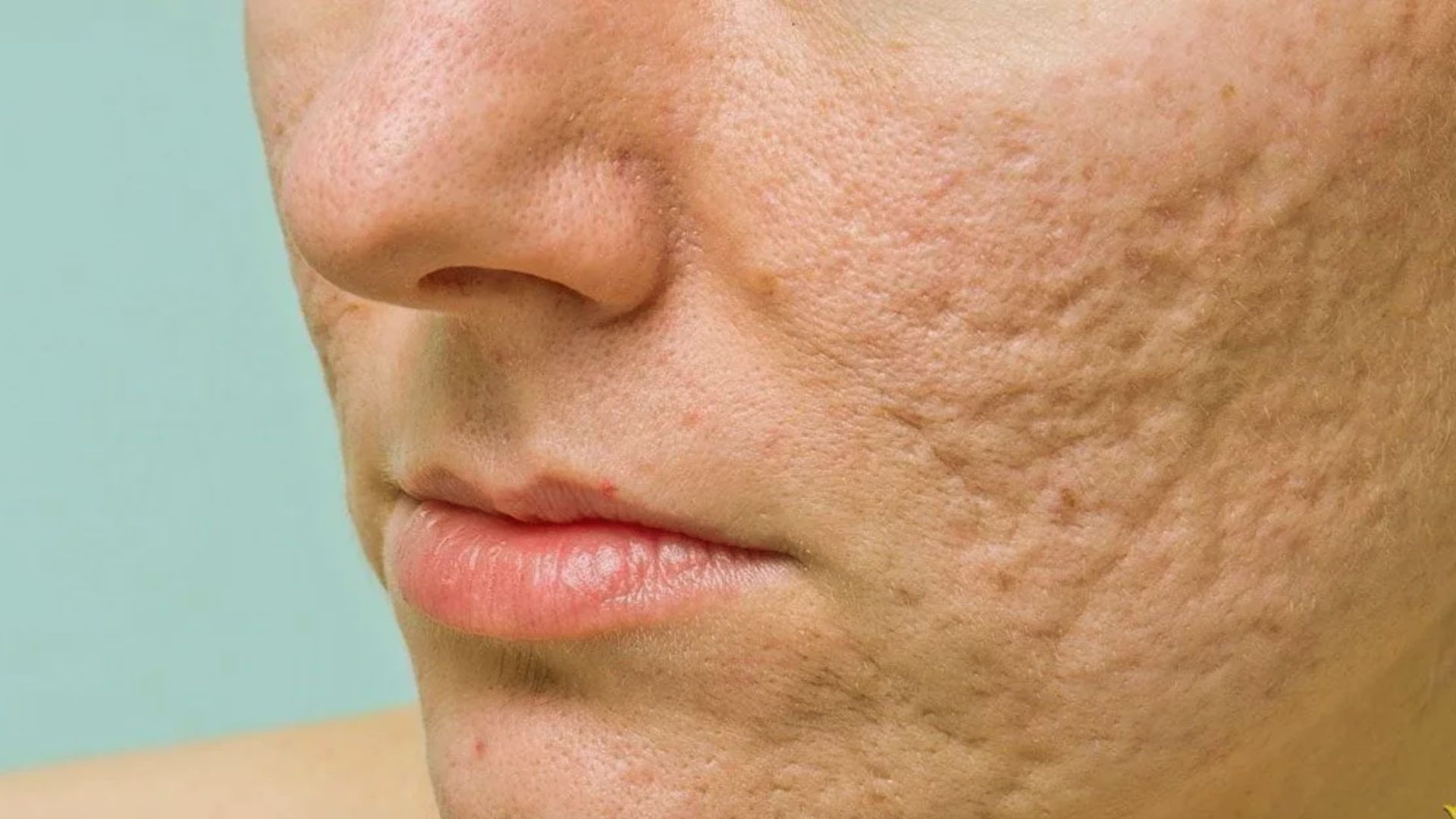 How Effective Is Microneedling for Acne Scars?