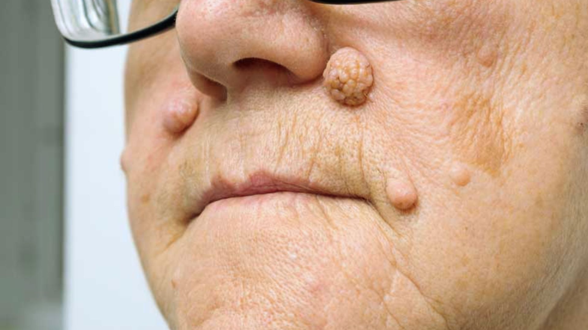 Close-up of an older woman with a prominent mole on her face, showcasing her facial features and expression.
