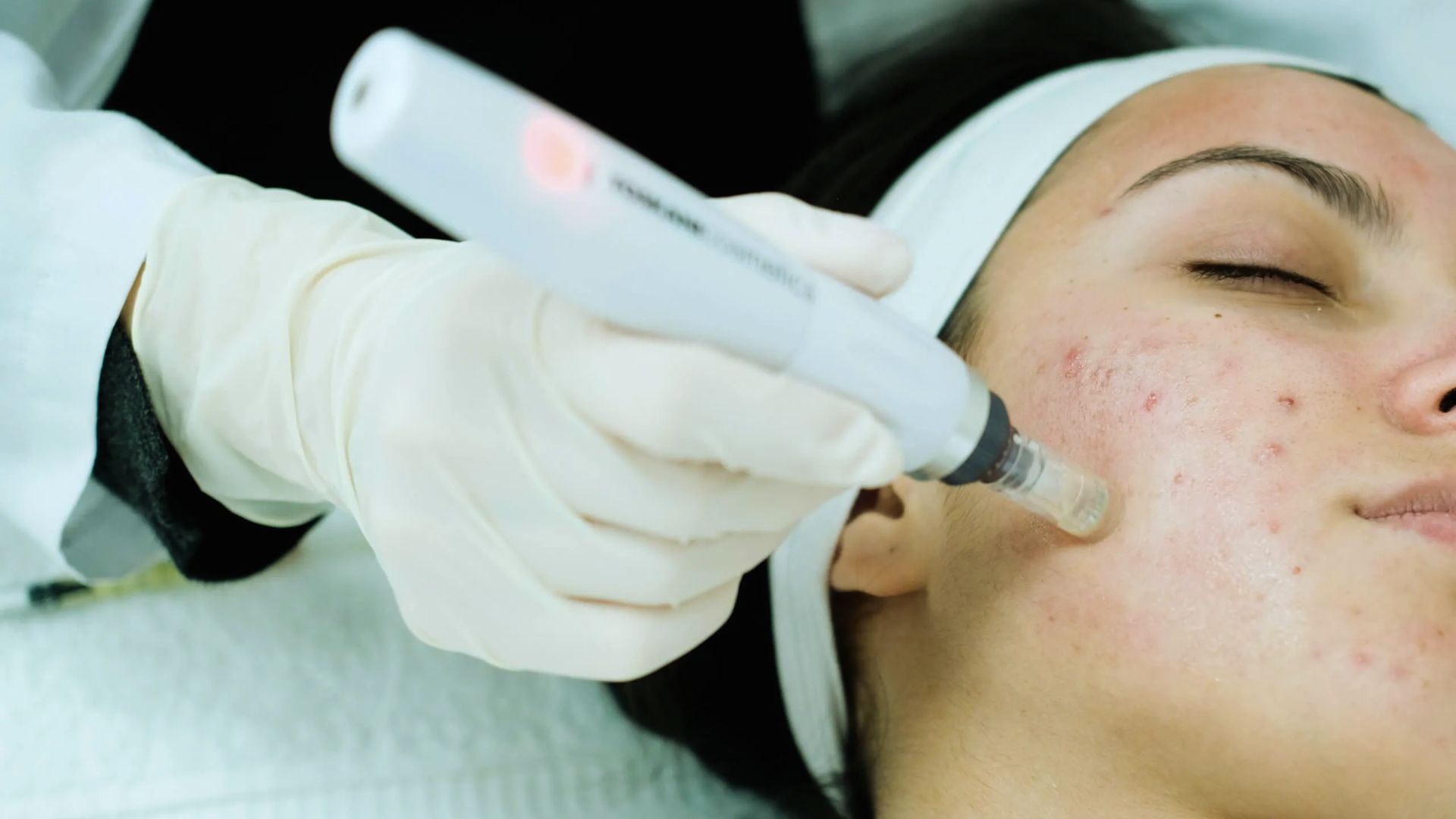 Is Microneedling Worth It for Acne Scars?
