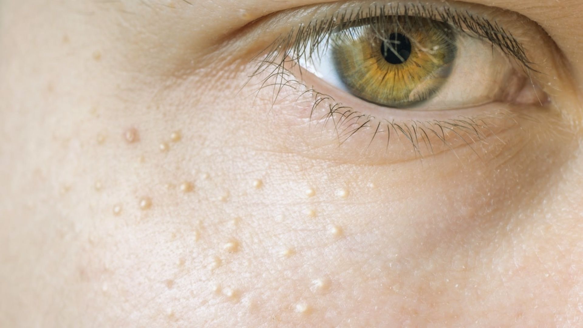 Close-up of a person's eye showing light brown iris and numerous small, white milia on the surrounding skin, conveying a focus on skin texture and condition.