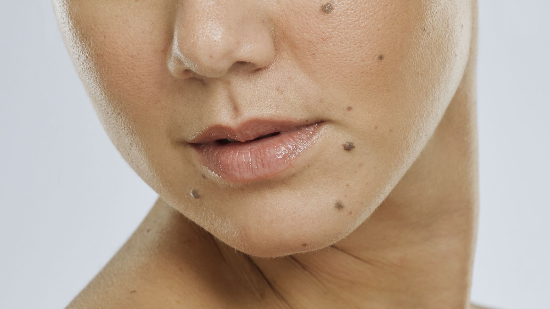 Close-up of a woman's lower face and neck, showing smooth skin with several moles, soft pink lips, and a neutral expression. The background is light gray.