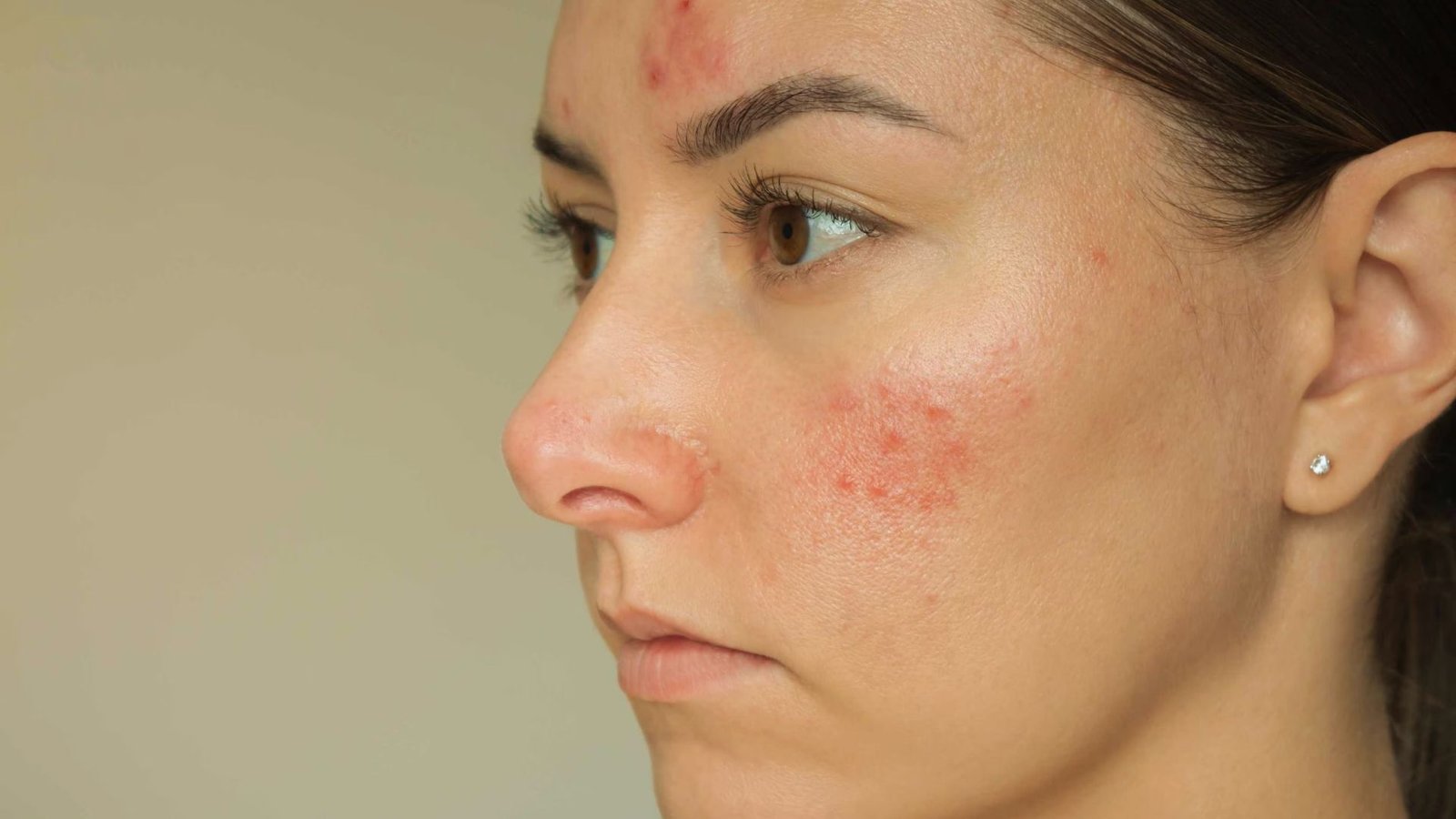 A woman with red spots on her face, looking directly at the camera with a neutral expression.