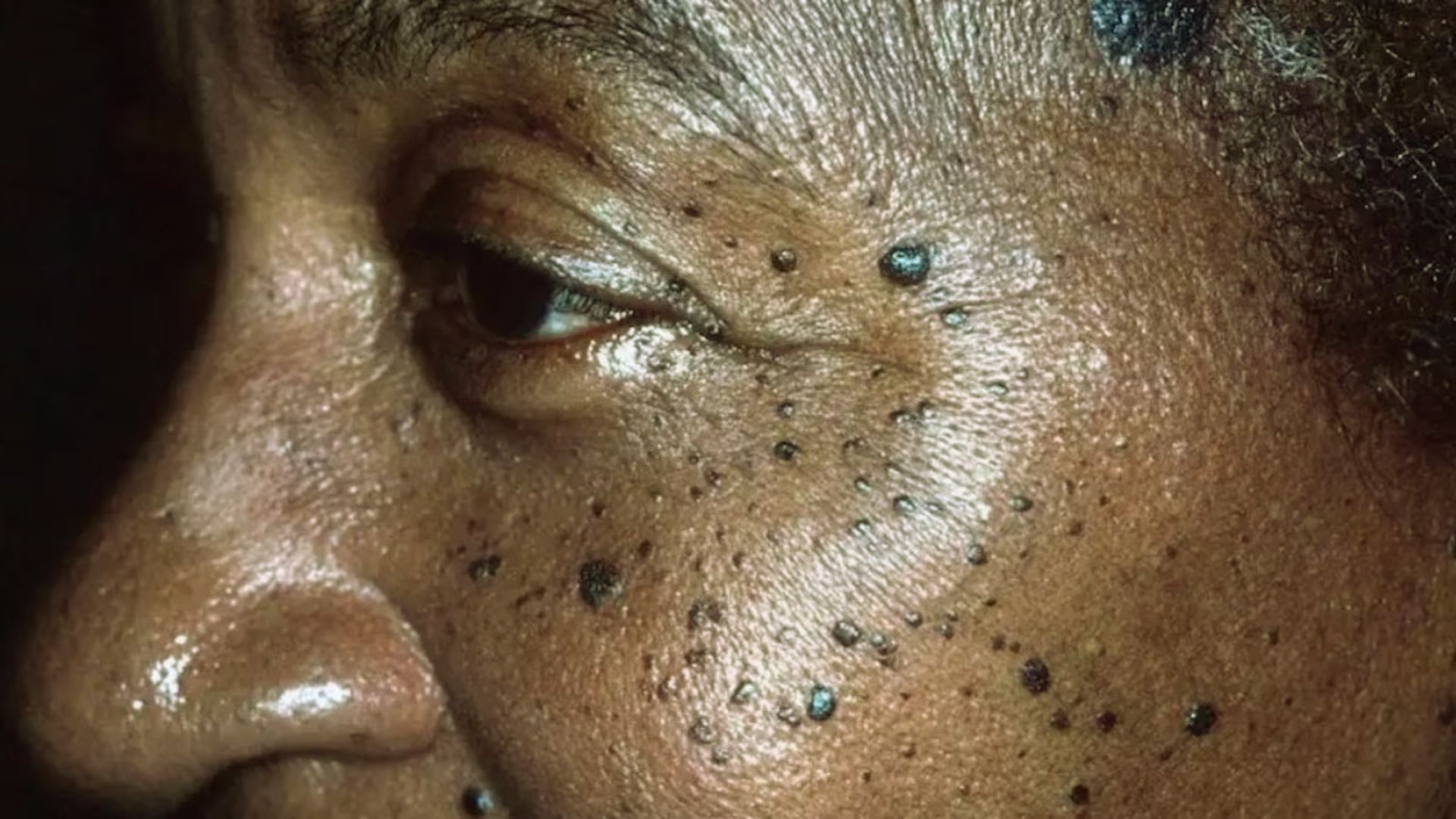 Close-up of a person's face with numerous small, raised dark spots on their cheek and around the eye. The skin appears textured and moist.