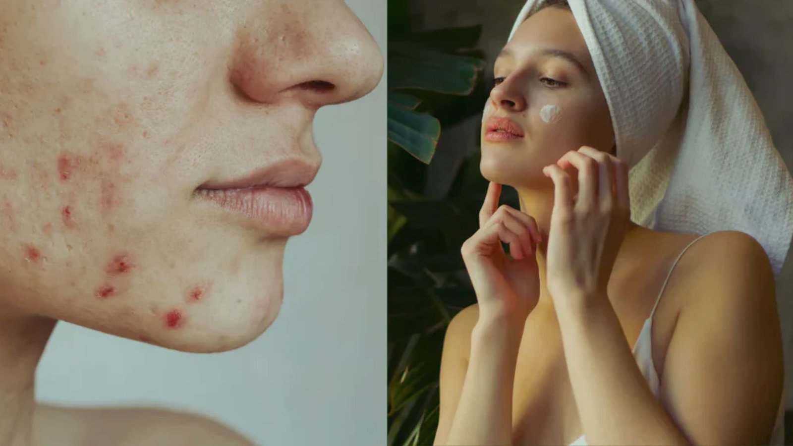 Split image showing a close-up of acne on a person's cheek and another image of the same person with a towel turban applying cream confidently.