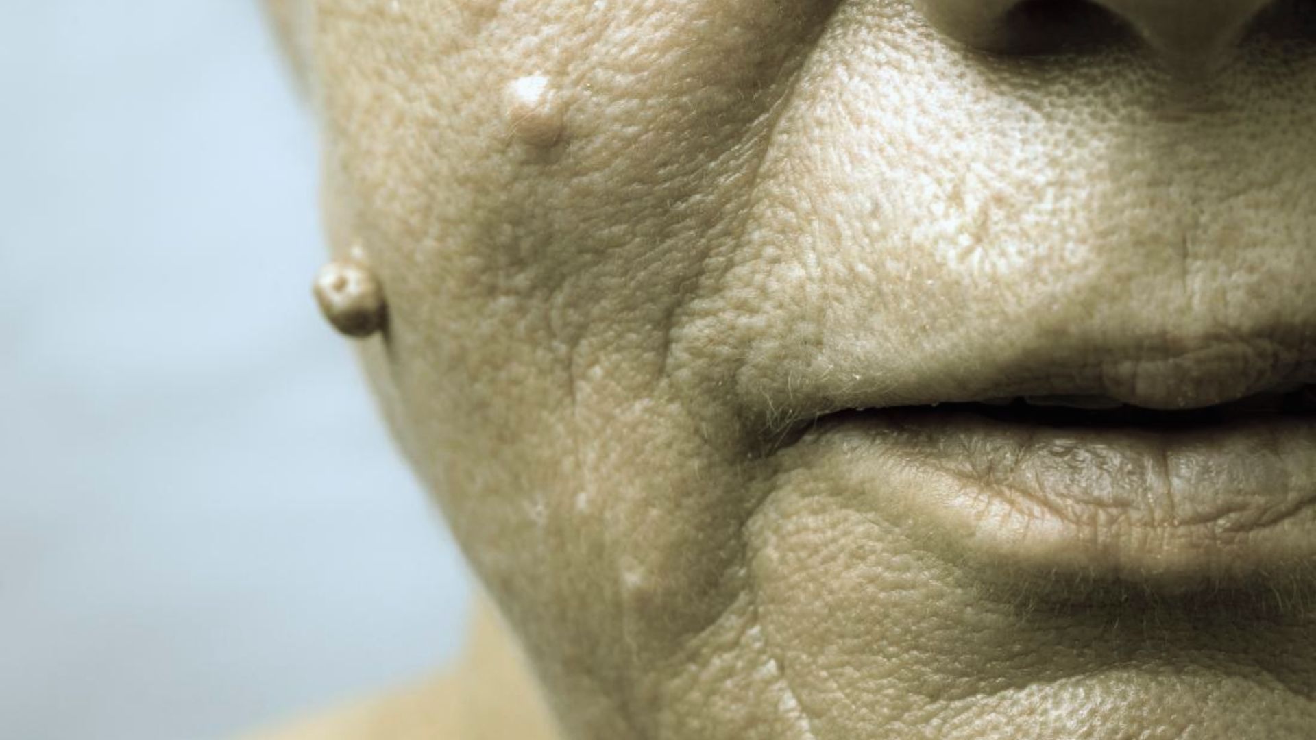 Close-up of an older woman's face highlighting a prominent pimple on her cheek.
