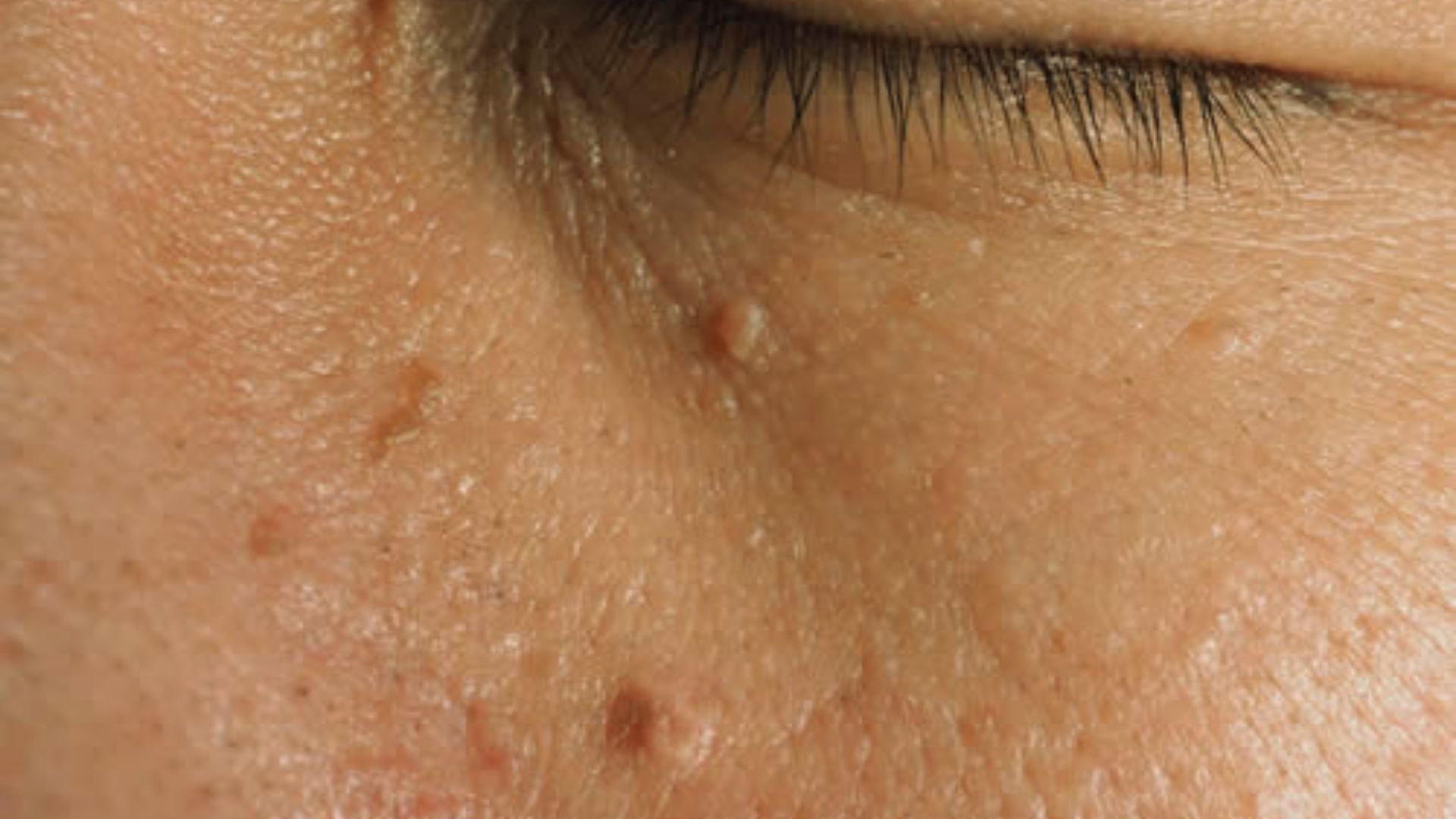 Skin Tags (Small Skin Growths on Face)