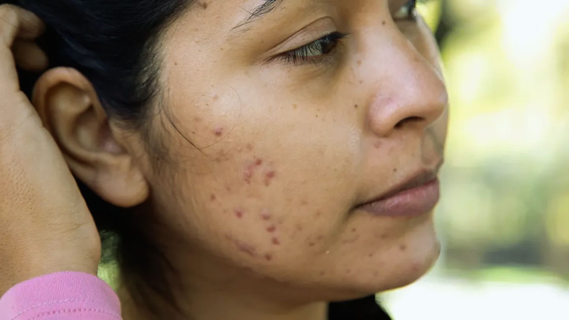 A woman with dark hair is seen in profile outside, showing acne on her cheek. She gently touches her hair, with a calm and contemplative expression.