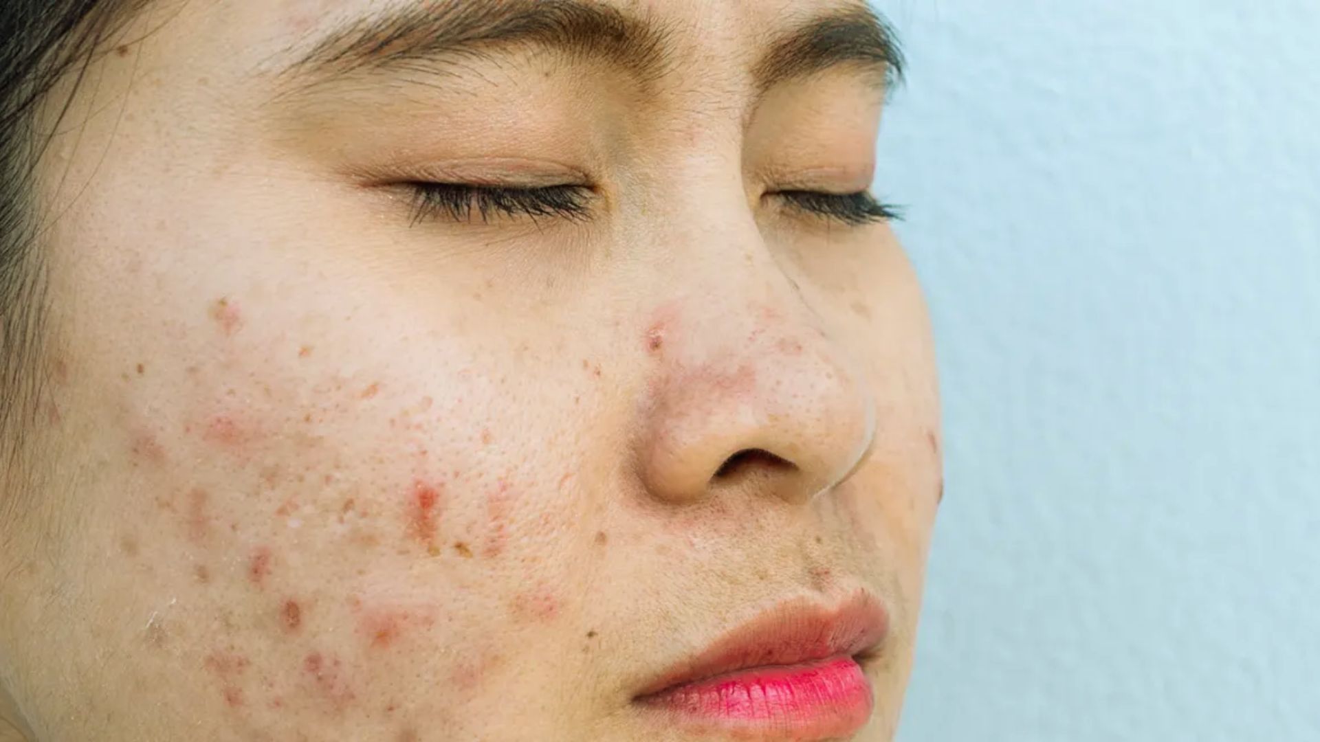 A woman with visible acne on her face, showcasing a range of skin textures and tones.