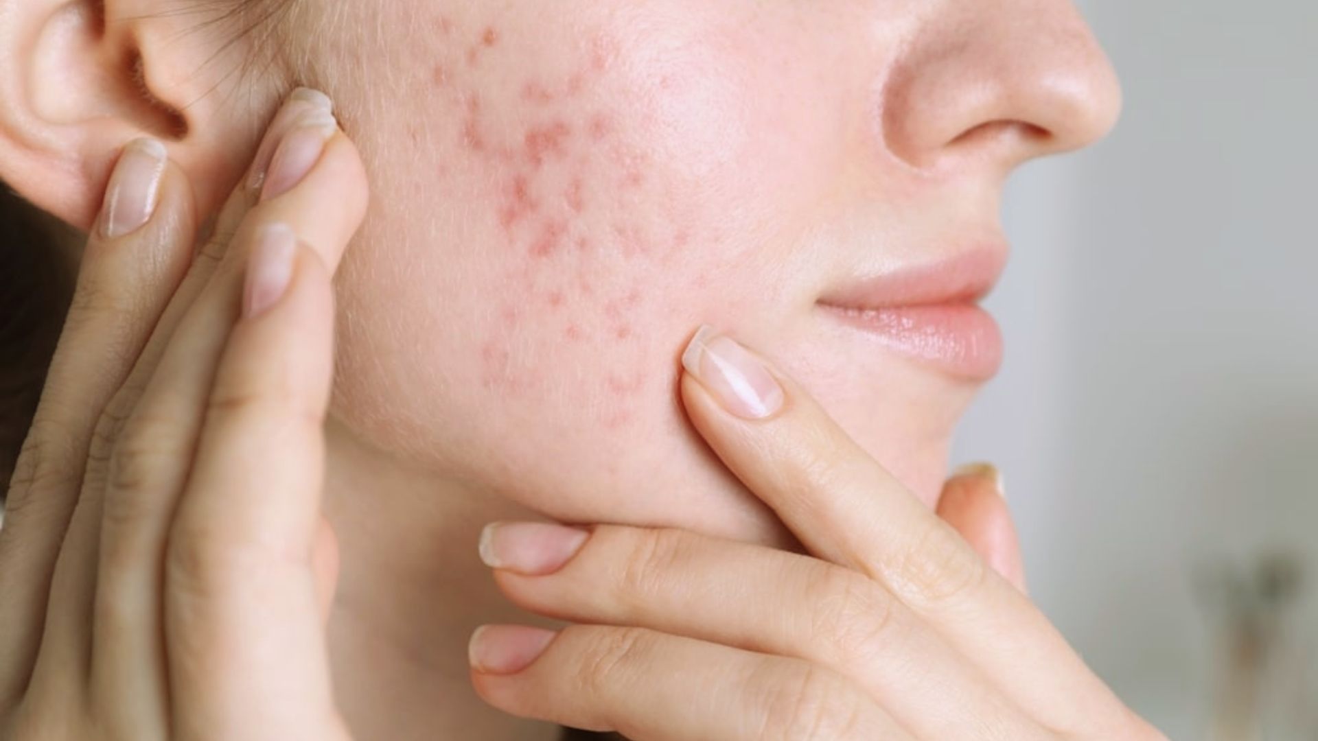 Acne treatment products specifically designed for women, featuring various skincare solutions and packaging.