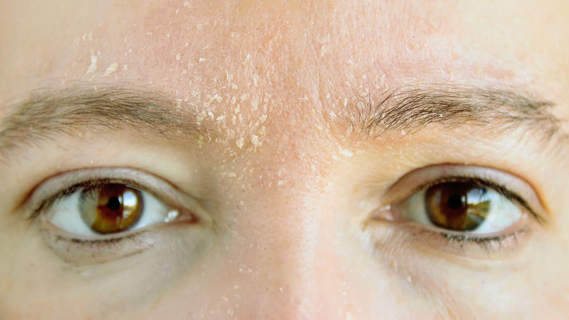 Close-up of a person's forehead and eyes, showing dry, flaky skin above the eyebrows. The image conveys a concern for skin health and texture.