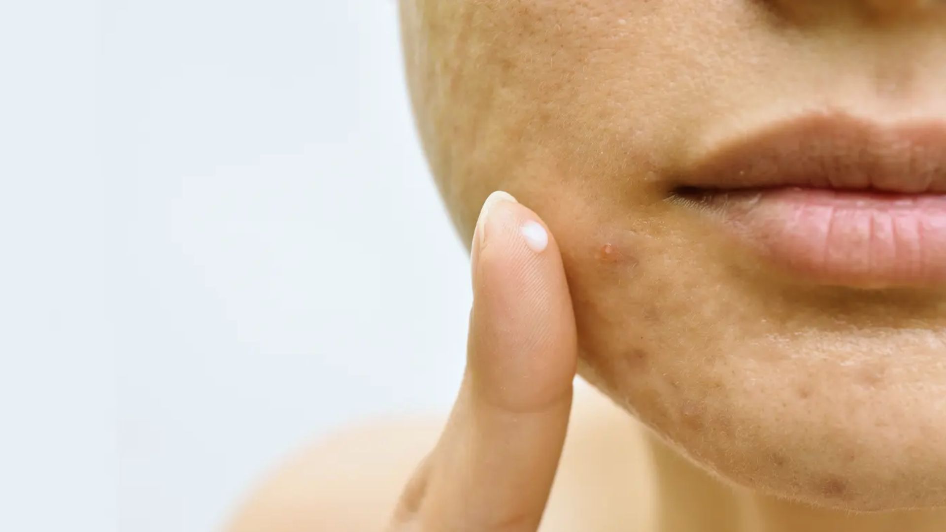 Close-up of a person's face with acne and a finger pointing at a pimple on the cheek. The skin texture is visible, conveying a focus on skincare concerns.