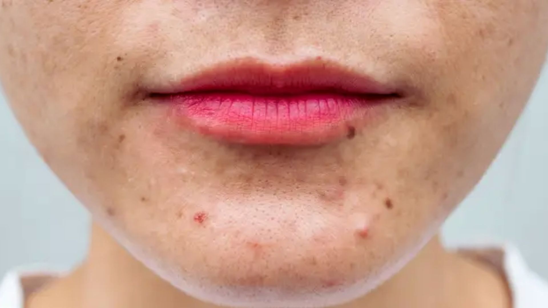 Close-up of a person's lower half of the face, showing red lipstick and acne on the chin. The skin appears textured with visible blemishes.