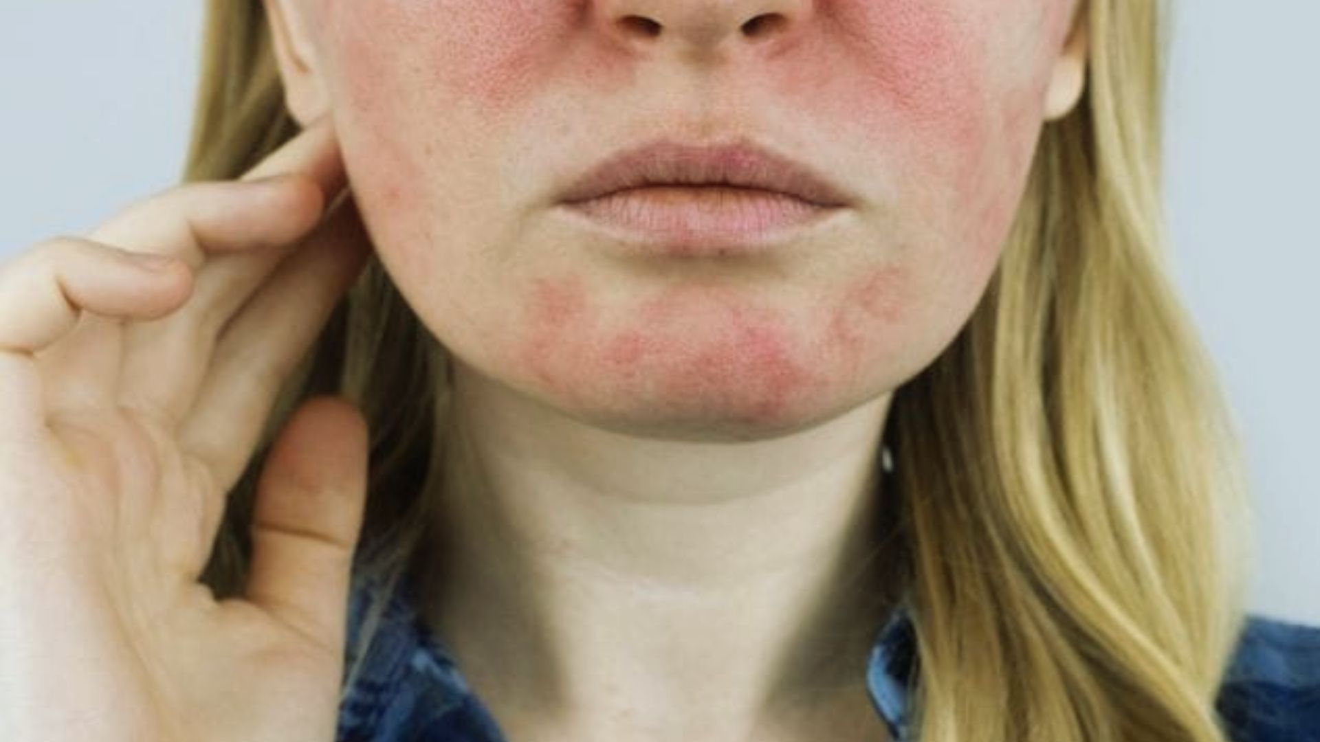 Close-up of a woman's face with red, inflamed skin on cheeks and chin, indicating irritation or dermatitis. She has a neutral expression.