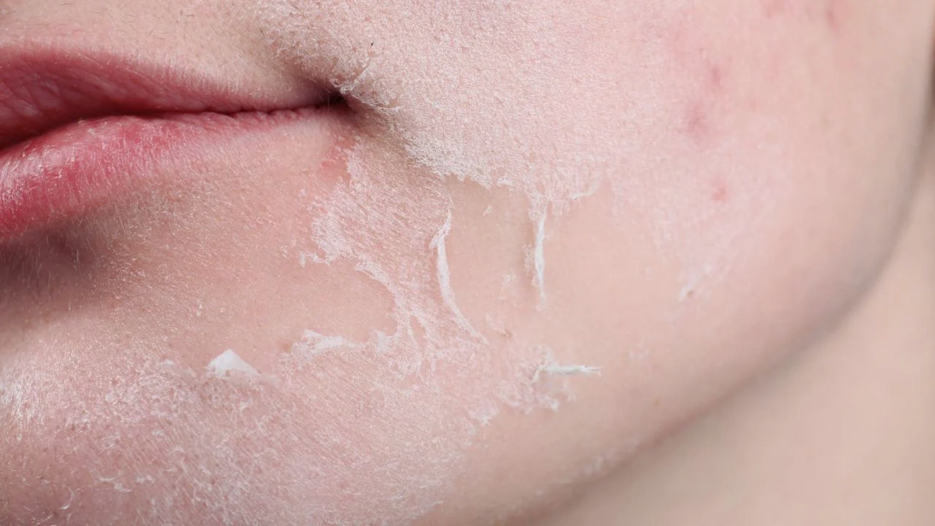 Close-up of a person's chin showing flaky, peeling skin. The texture suggests dryness or irritation, with a slightly pinkish tone visible.