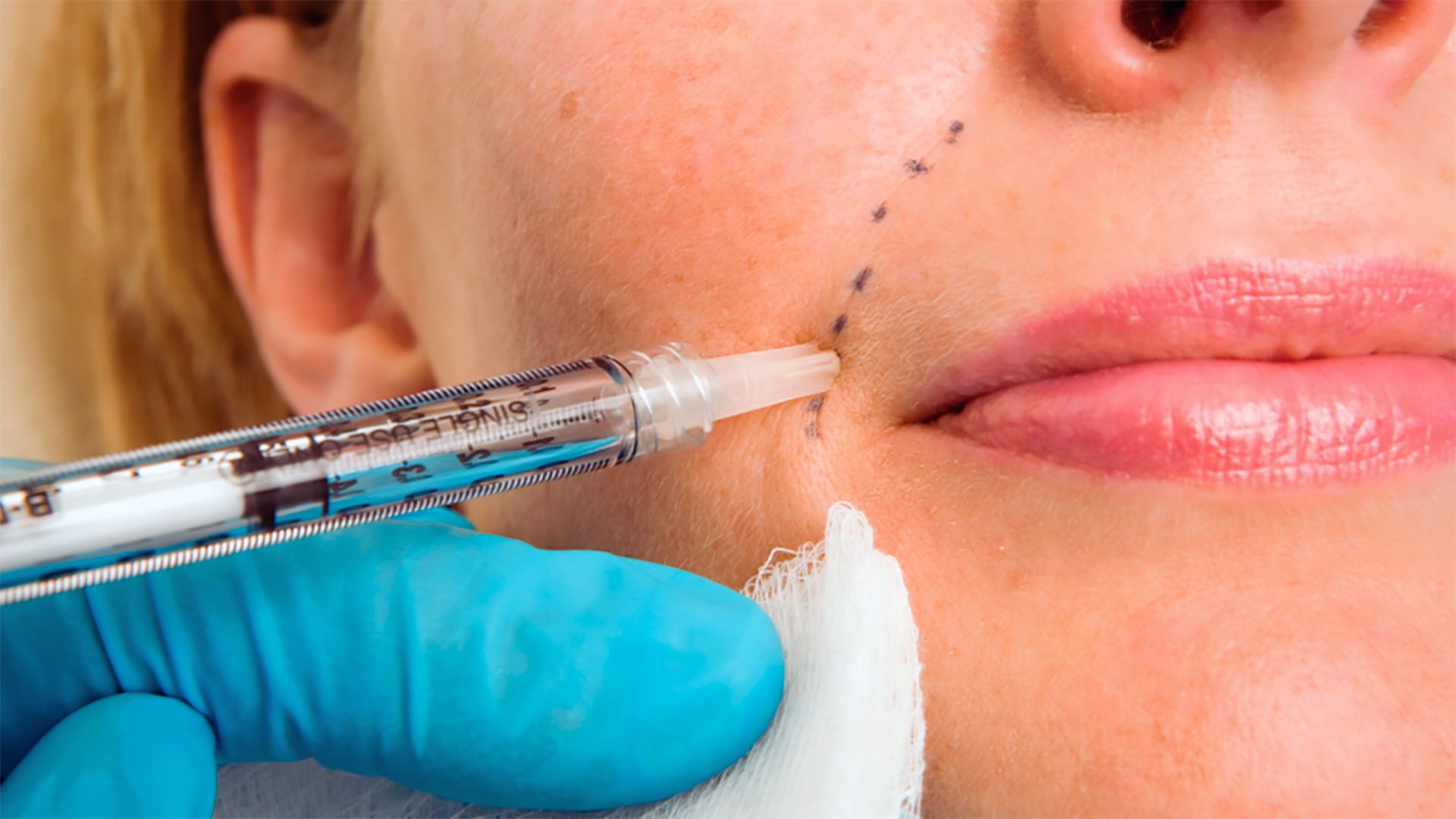 What is Dermal Filler?