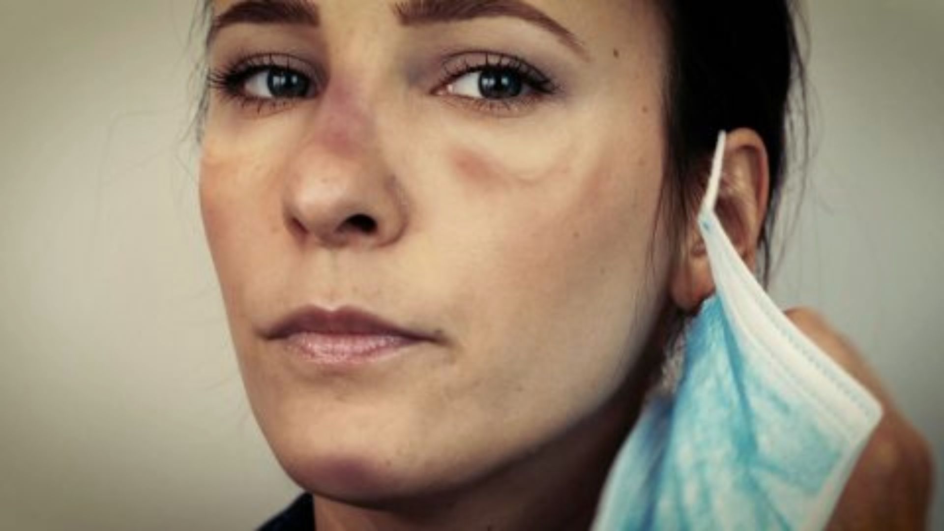 A woman with a blue bandage on her face, looking directly at the camera with a neutral expression.