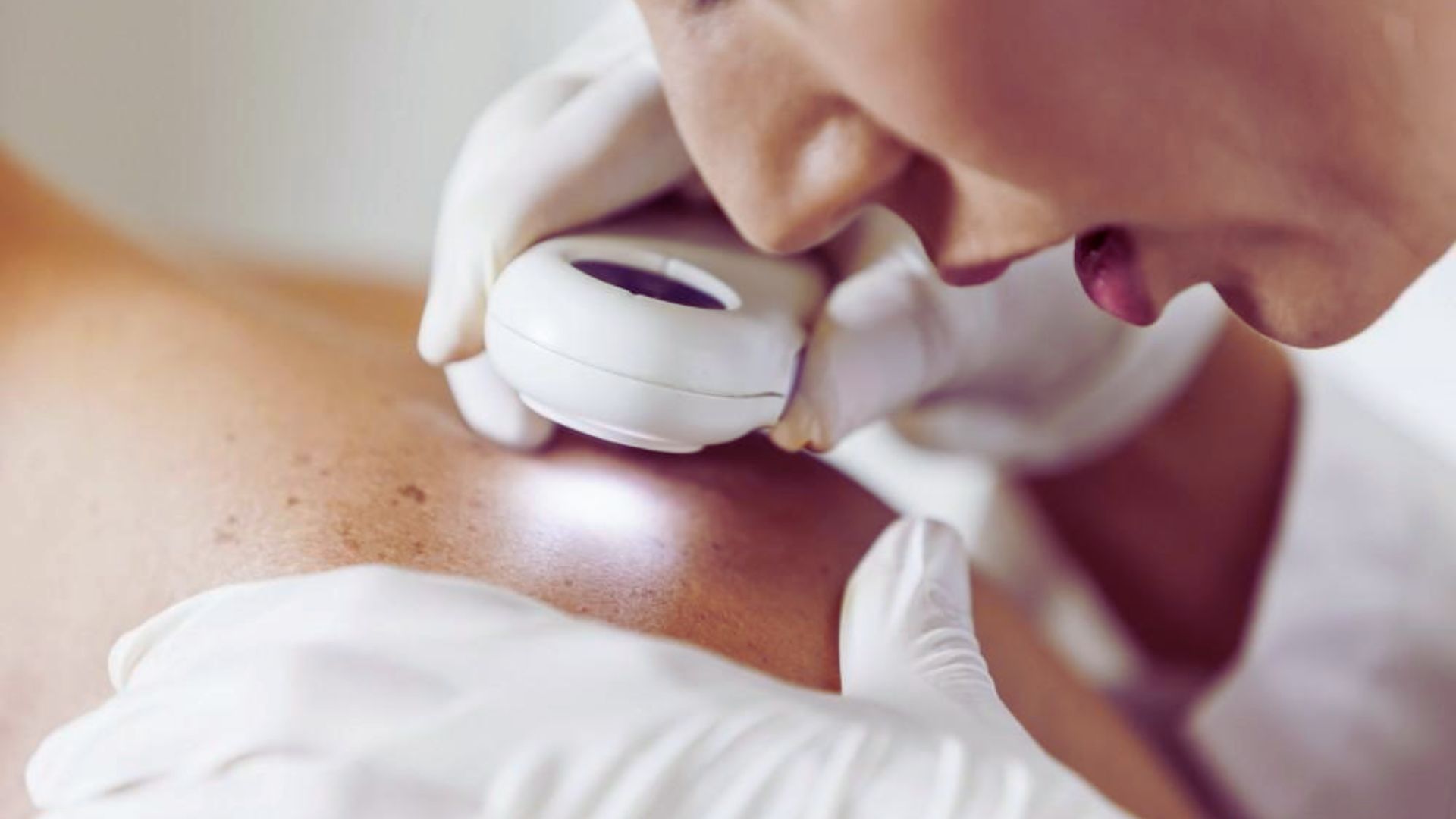 A woman receiving laser treatment on her skin, focused on improving her complexion and skin texture.