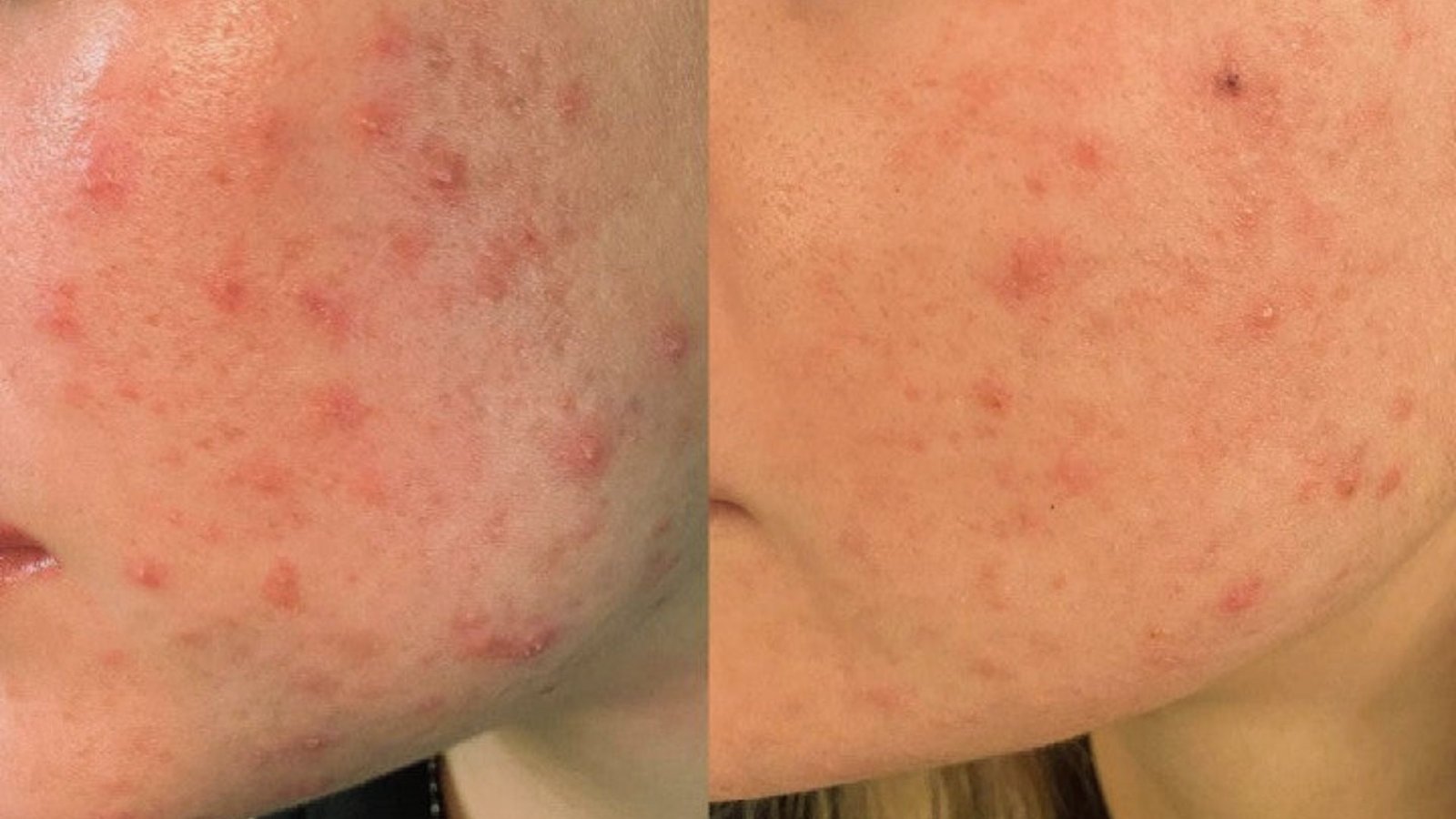 Before and after images showcasing the effectiveness of acne treatment on skin clarity and texture improvement.
