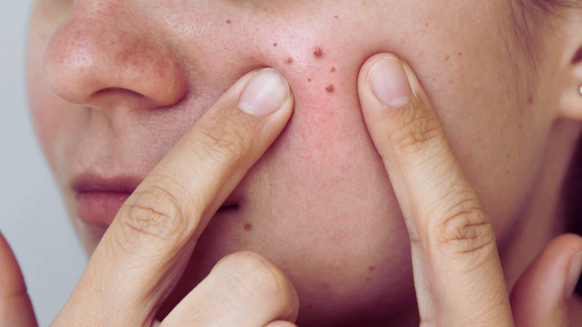 A woman with visible acne on her face, showcasing a range of skin textures and tones.