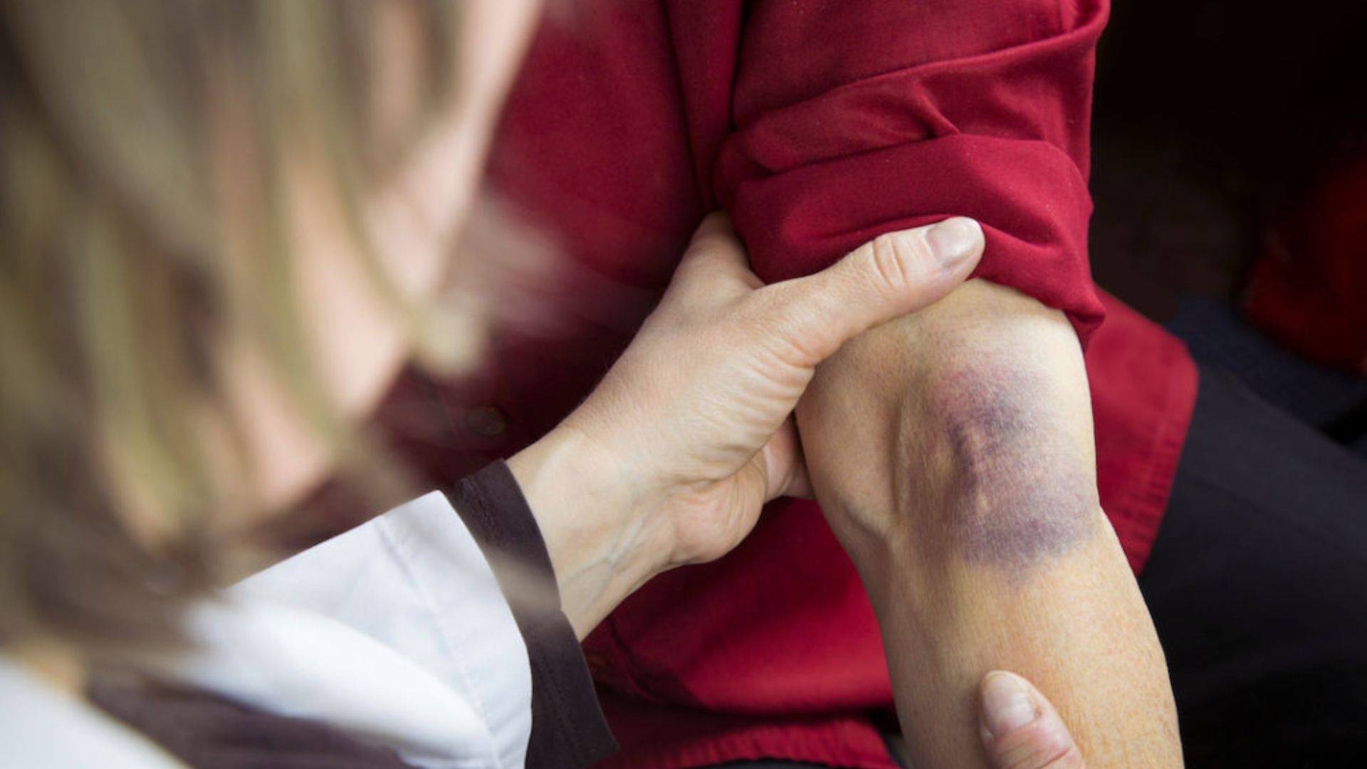 A woman showing a bruise on her arm, indicating a recent injury or impact.