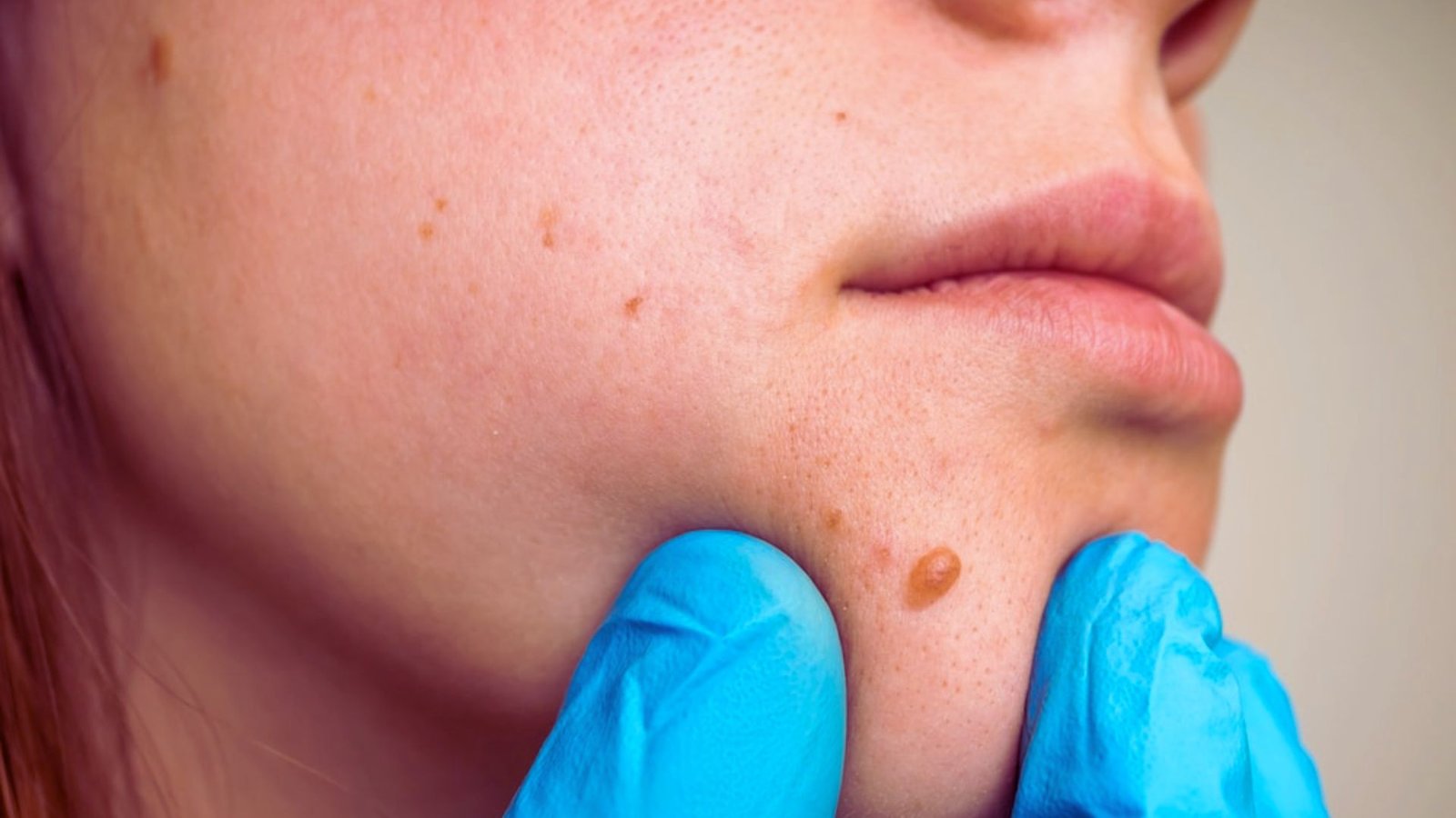 Does Skin Cancer Have Pus