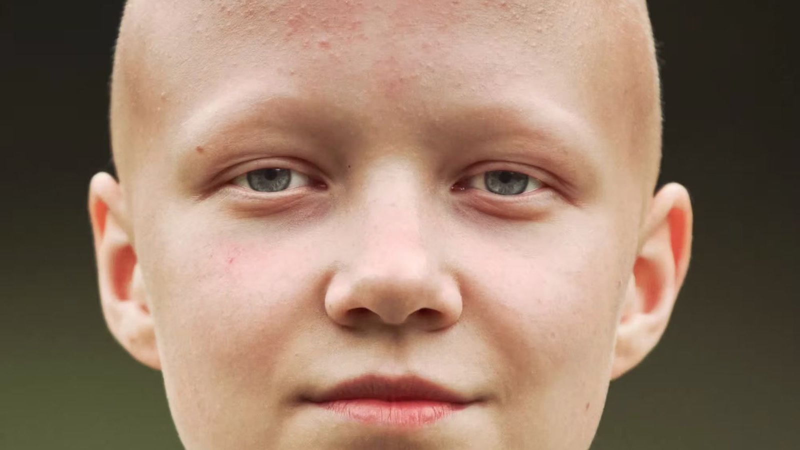 Why Do People With Alopecia Lose Eyelashes