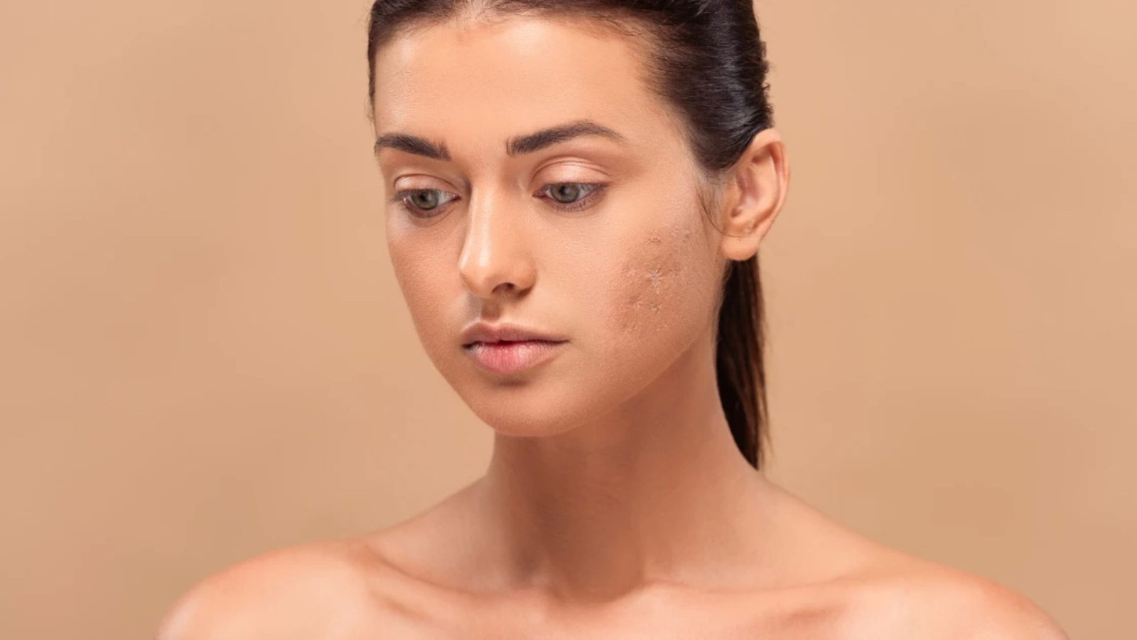 A woman with visible acne on her face, showcasing her natural skin texture and features.