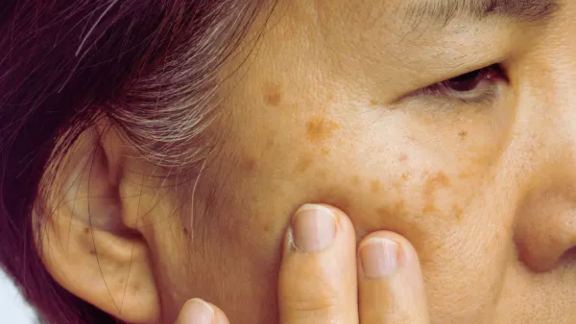 Understanding Sun Damage