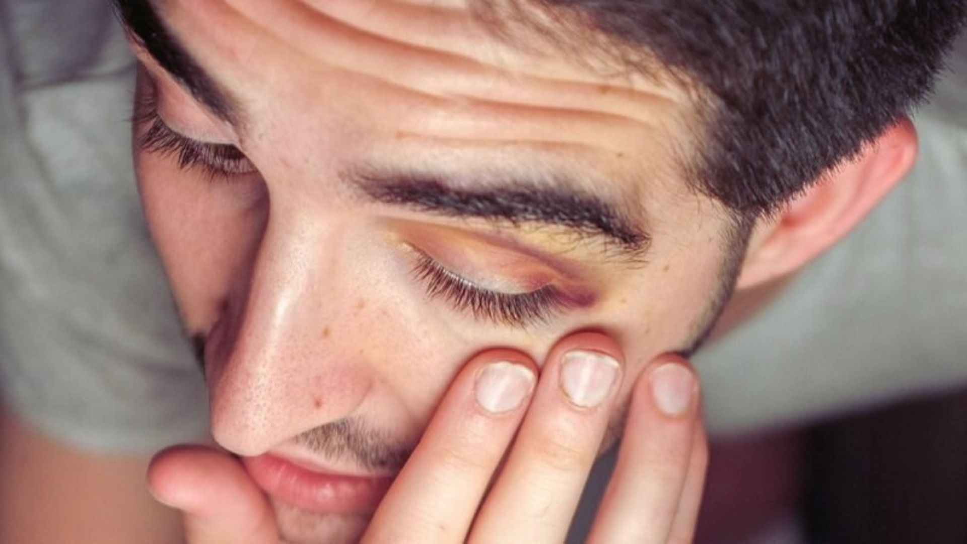 A man with a bruised eye, resting his hand on his face, appears contemplative and in distress.