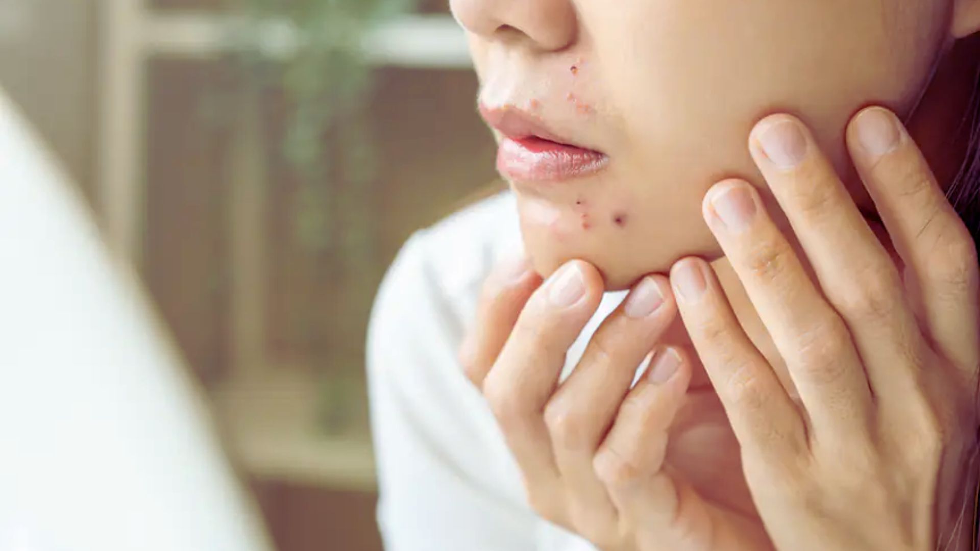 A woman with visible acne on her face, showcasing her natural skin texture and features.