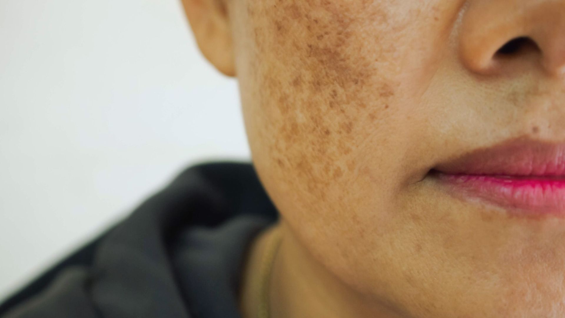 Can You Really Fix Sun Damaged Skin