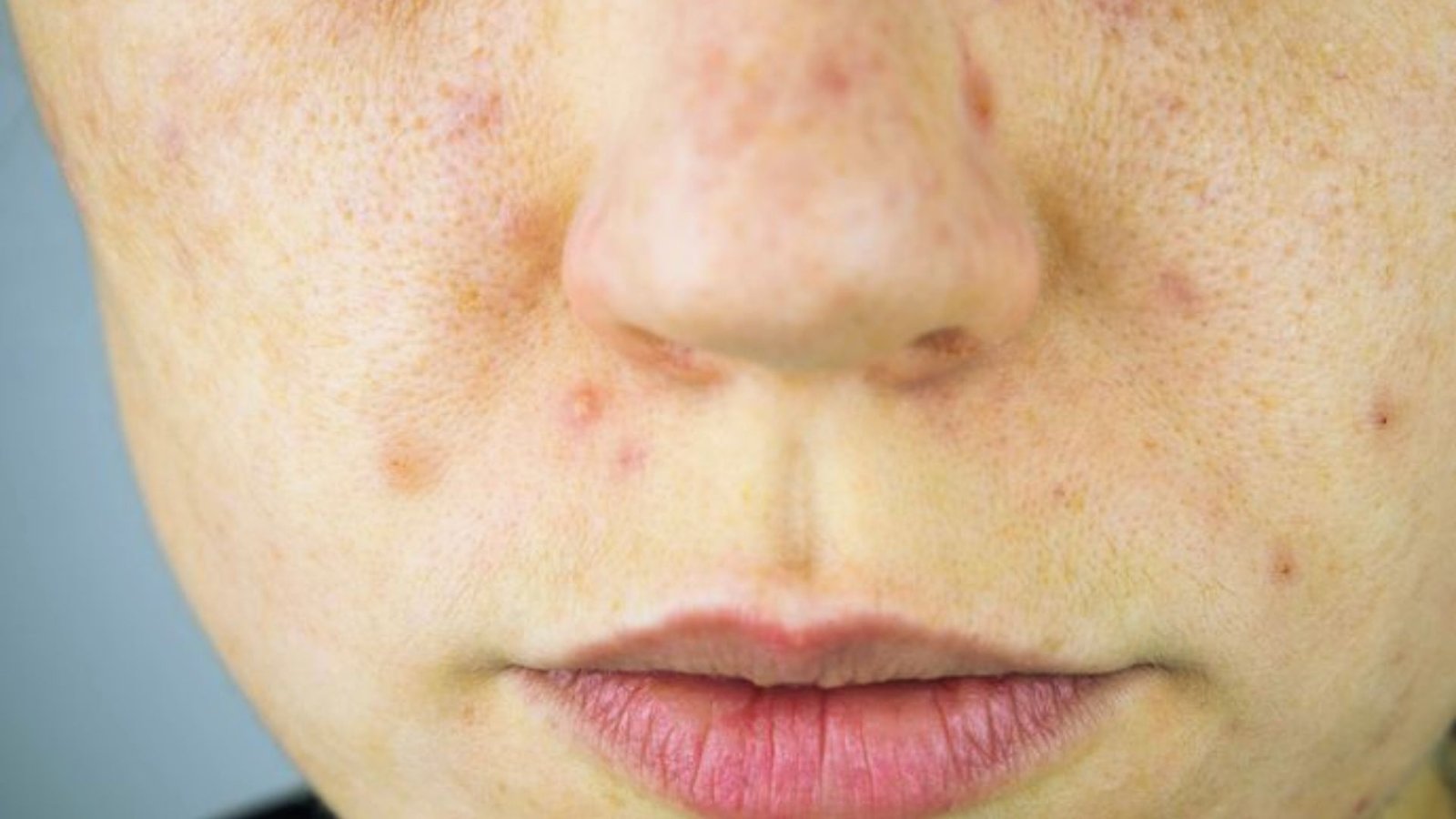 Pore-Clogging Ingredients
