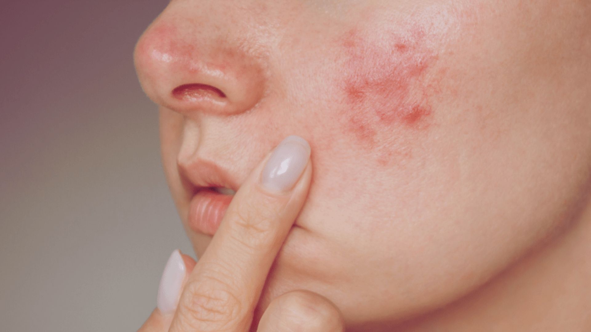 A woman with red spots on her face, looking directly at the camera with a neutral expression.