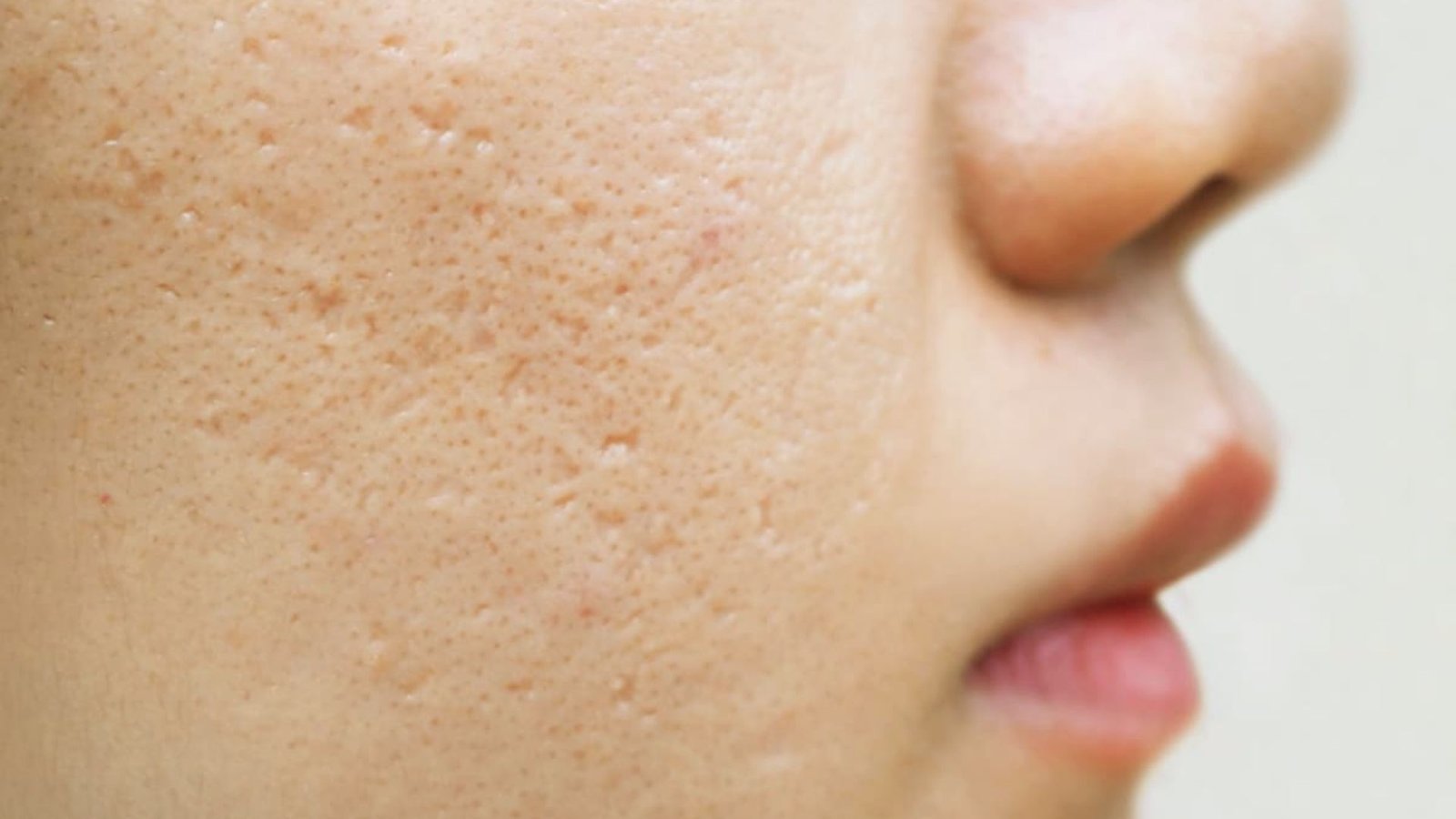 Close-up of a woman's face showing significant acne, highlighting skin texture and imperfections.