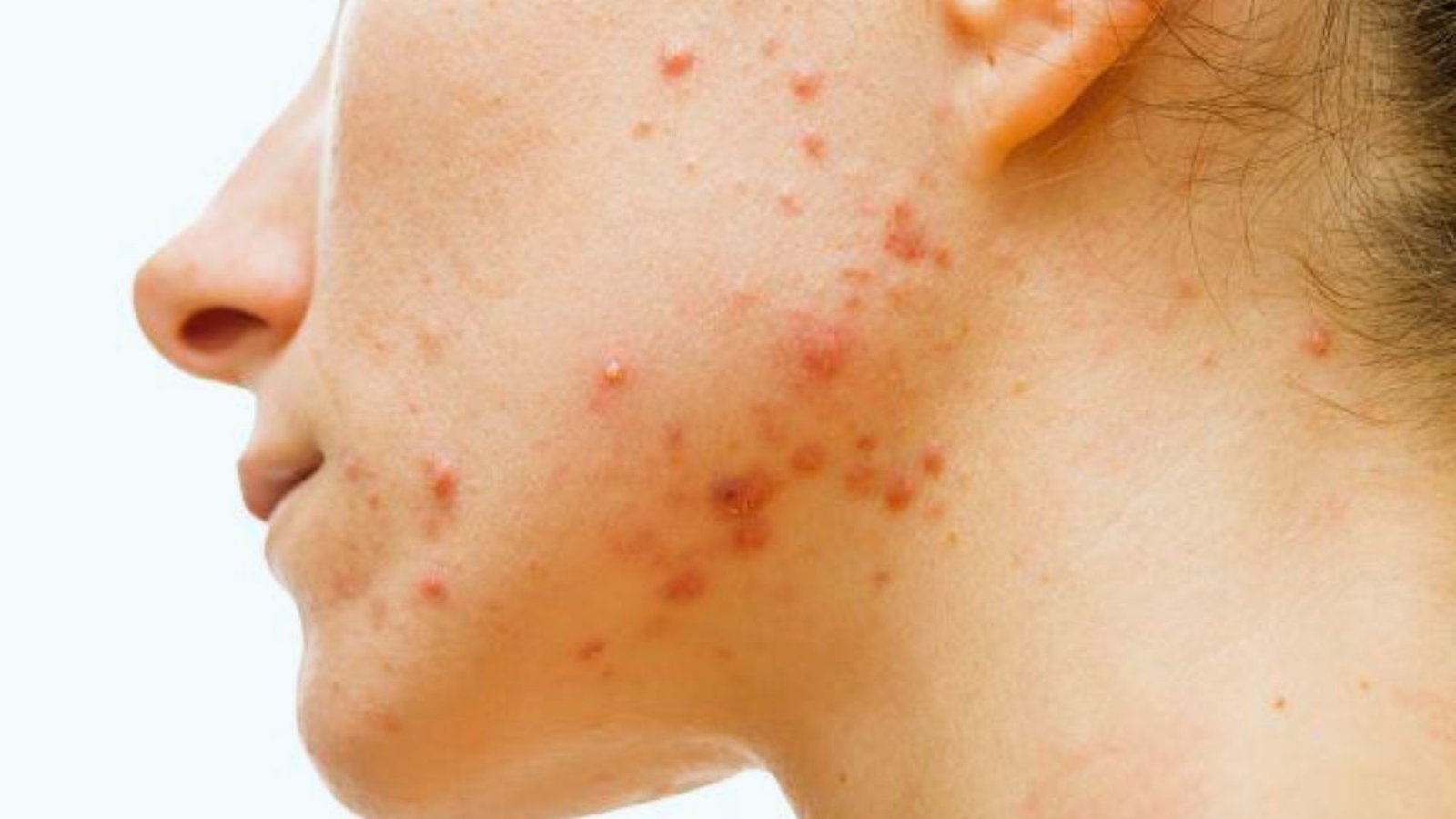 A close-up of a woman's face showing visible acne on her cheeks and forehead.