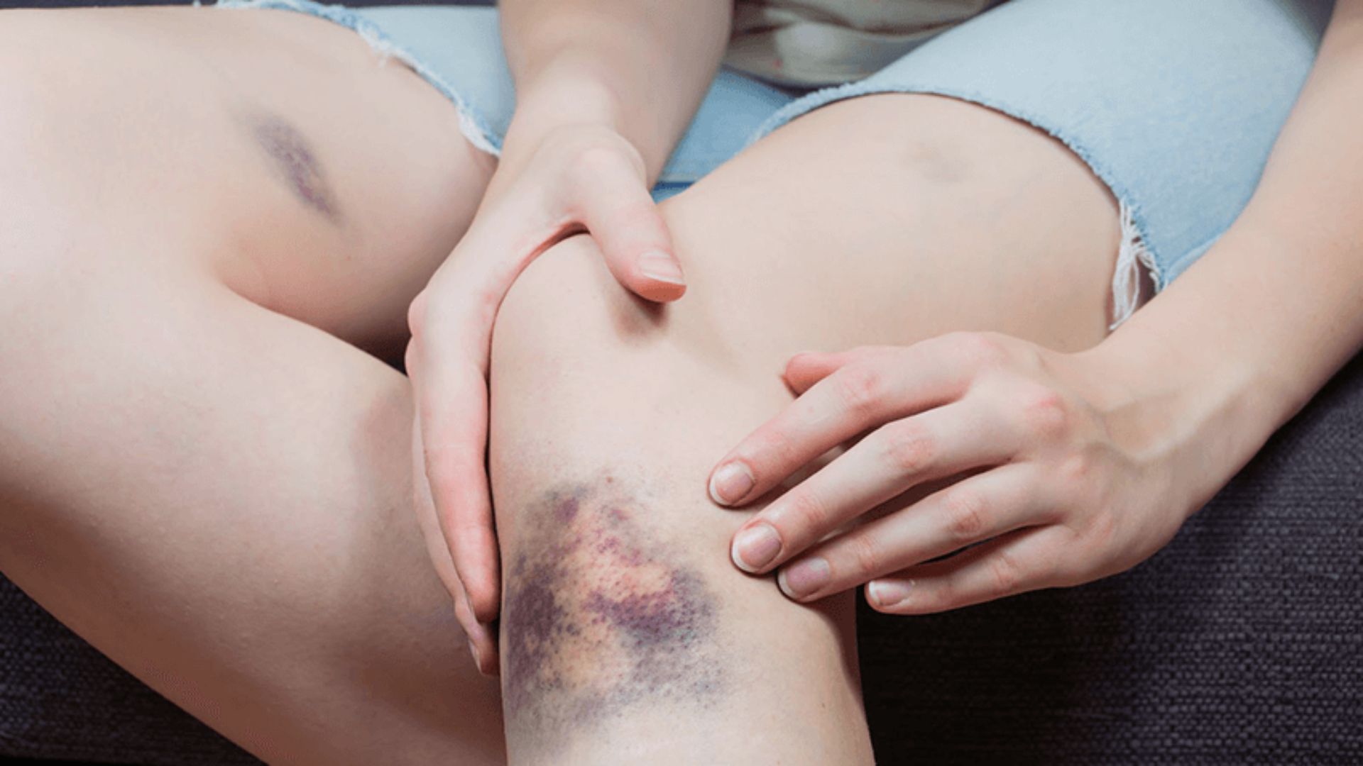 A woman with a knee injury sits on a couch, resting her leg while looking thoughtfully ahead.