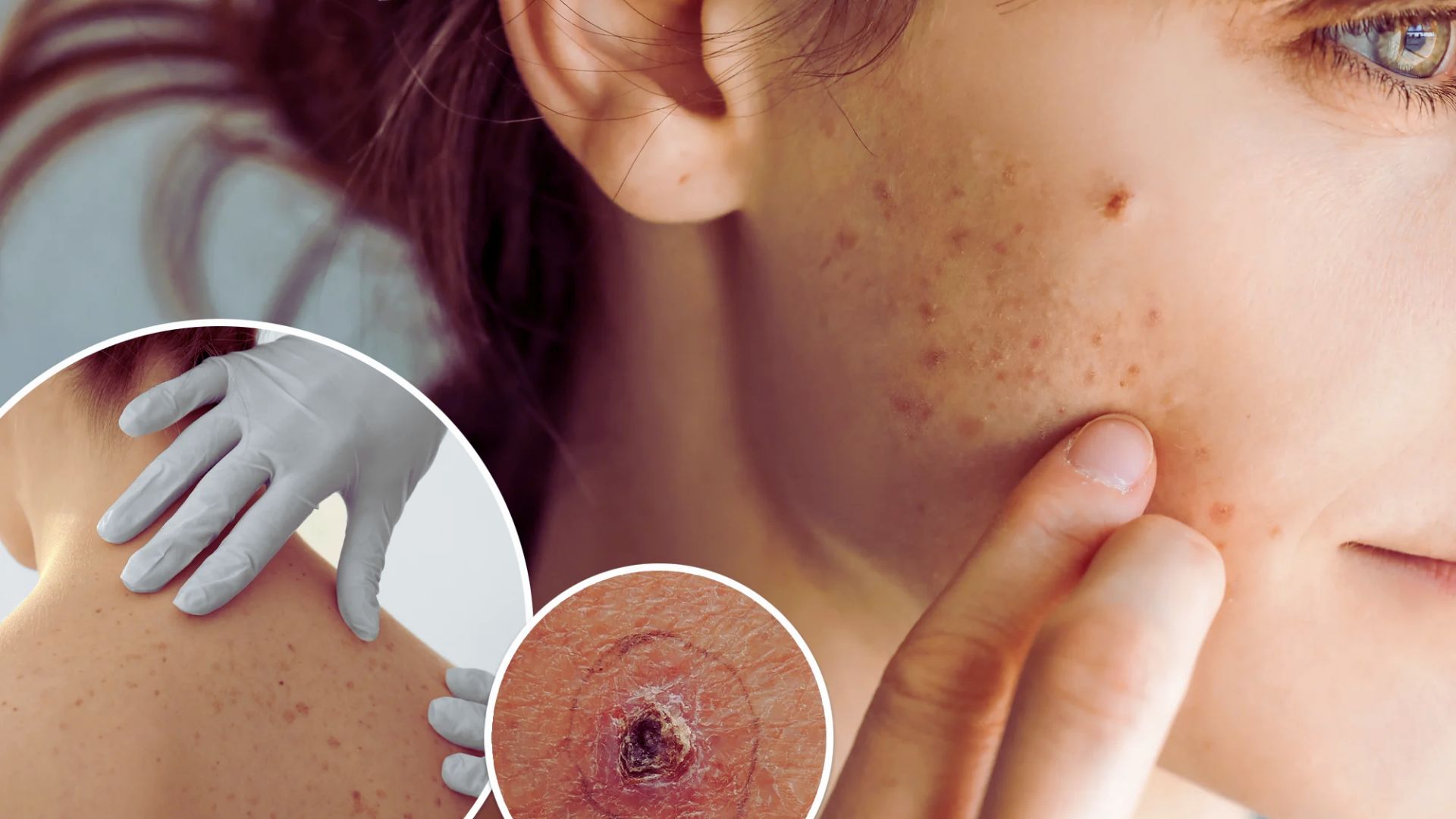 A close-up image of a woman's back showing acne, highlighting the texture and condition of her skin.
