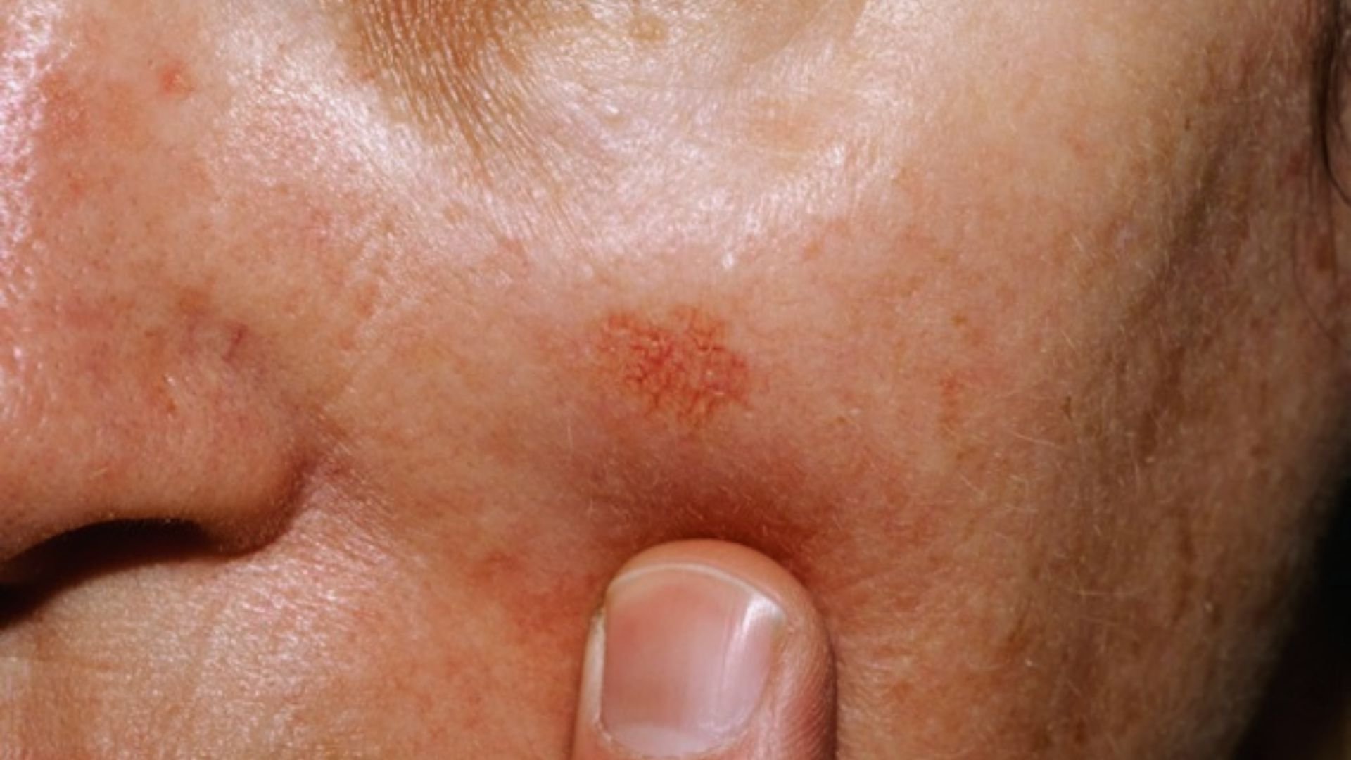 How to Treat Sun Damaged Skin Effectively