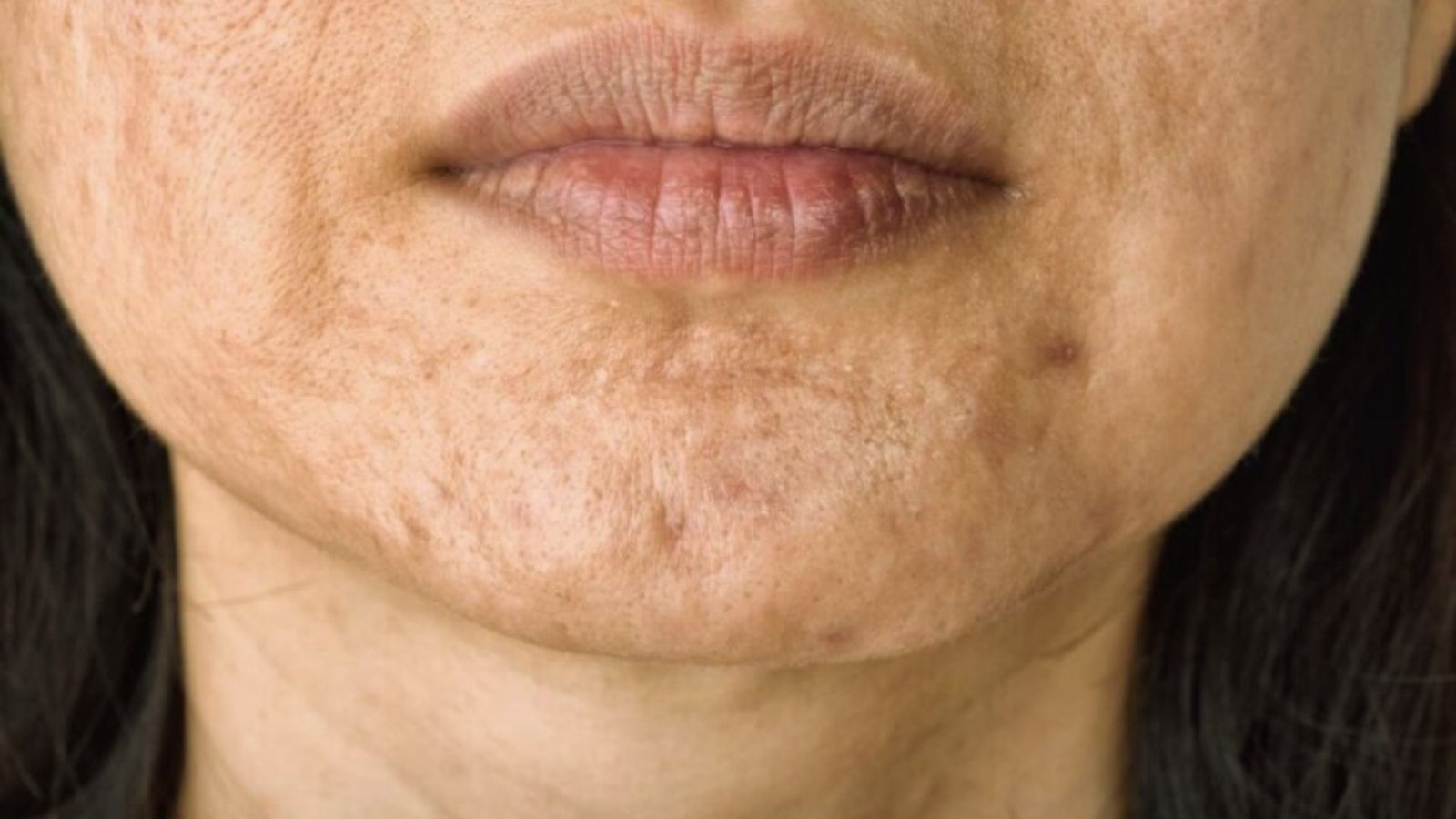 Does Exfoliating Help With Scars