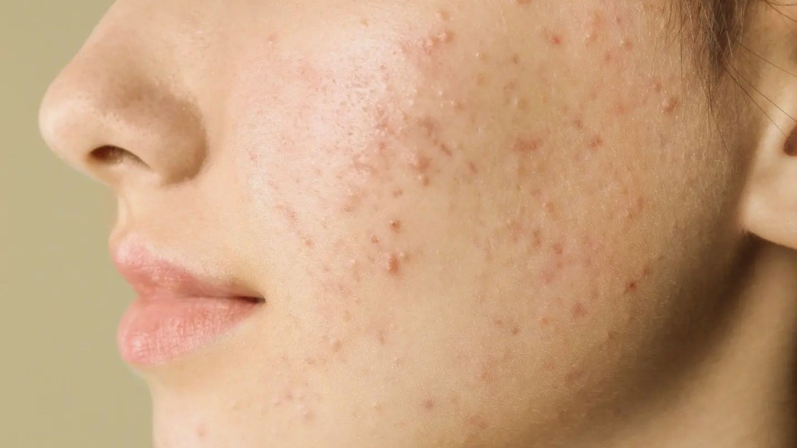 Image illustrating acne, a common skin condition influenced by various factors affecting individuals' skin health.