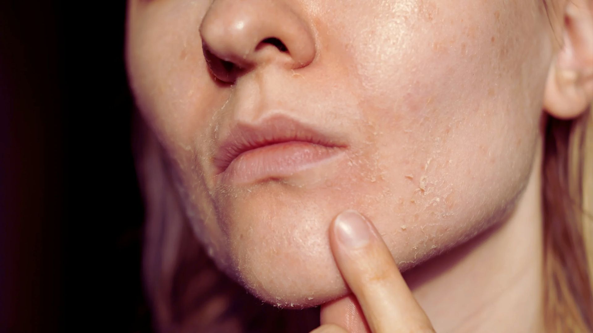 A woman with a visible pimple on her cheek, looking thoughtfully at the camera.